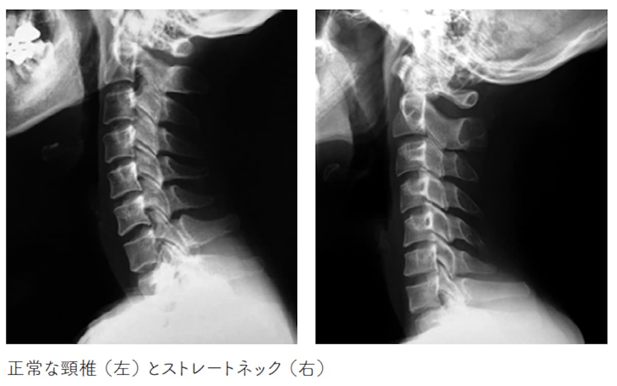 正常な頸椎（左）とストレートネック（右）